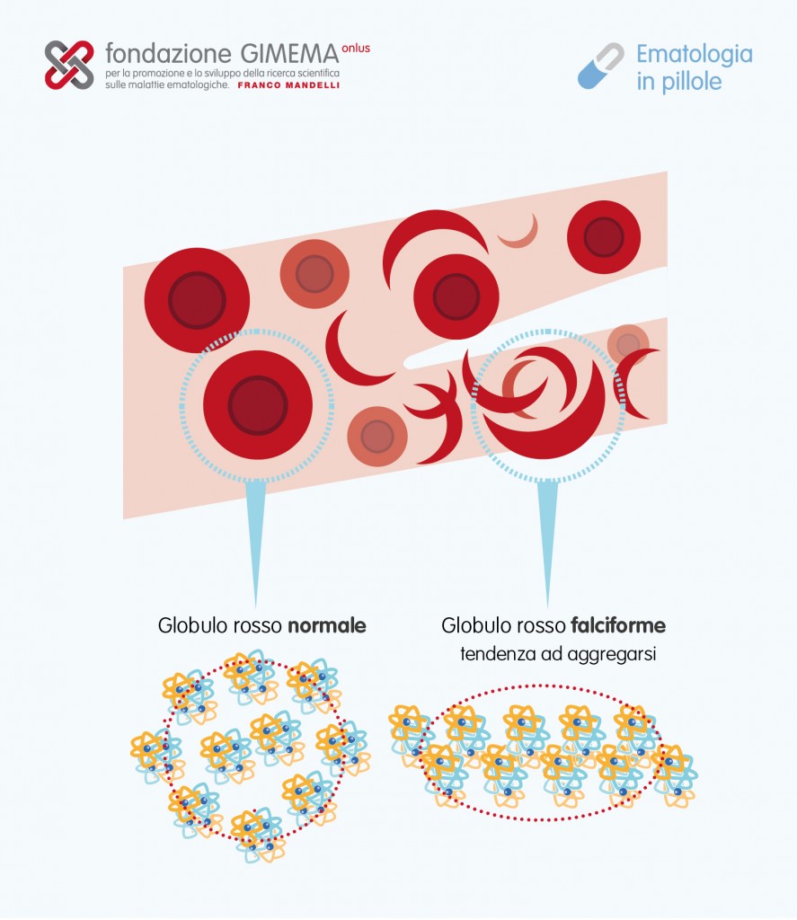 Anemia Falciforme – Ematologia in pillole – Fondazione GIMEMA