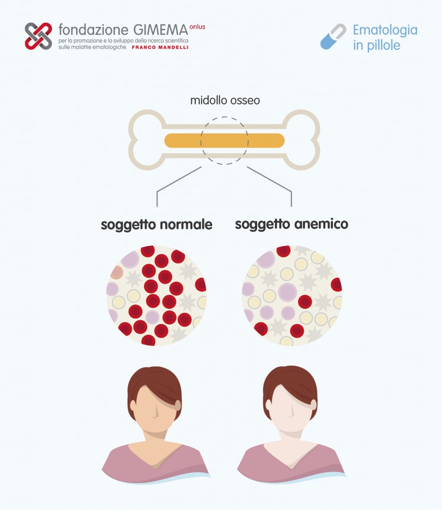 Anemia aplastica – Ematologia in pillole – Fondazione GIMEMA