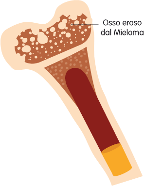 Osso eroso dal mieloma – Mieloma Multiplo – Fondazione GIMEMA