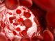 anemia falciforme terapia genica