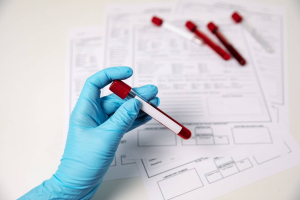 diagnosi mielofibrosi primaria prefibrotica