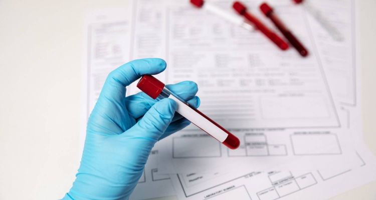 diagnosi mielofibrosi primaria prefibrotica