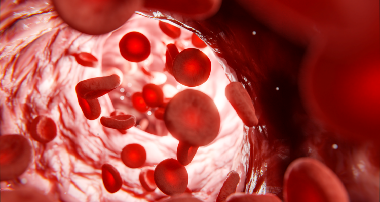 trombosi venosa profonda