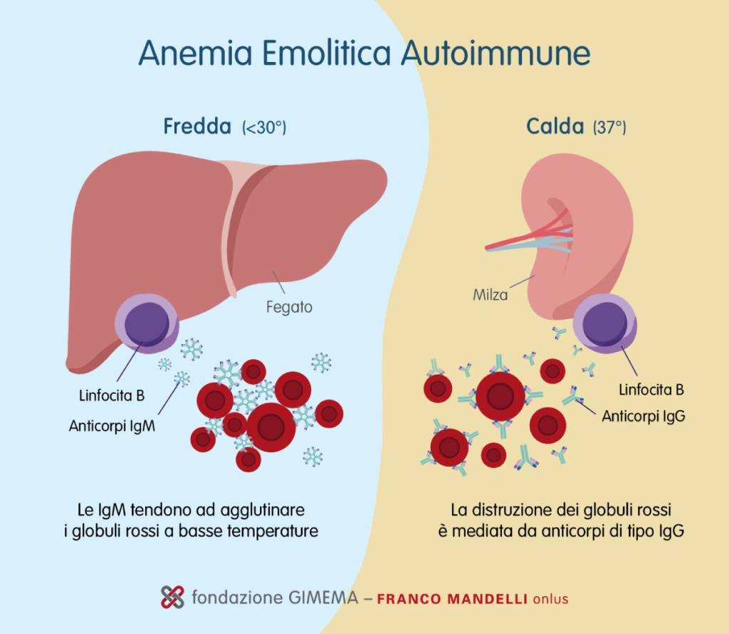 Anemia emolitica autoimmune - Fondazione GIMEMA
