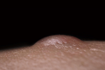 Linfomi cutanei primari a cellule B