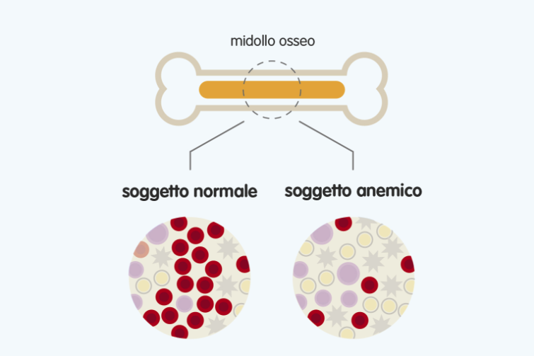 anemia mielofibrosi
