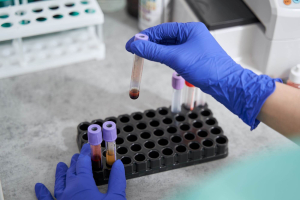 leucemia linfatica cronica malattia residua