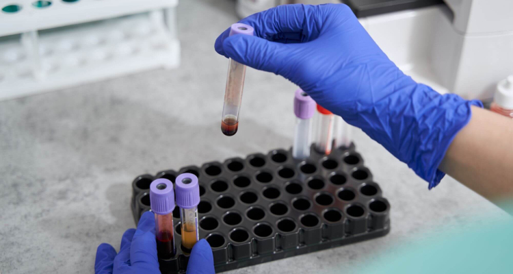 leucemia linfatica cronica malattia residua